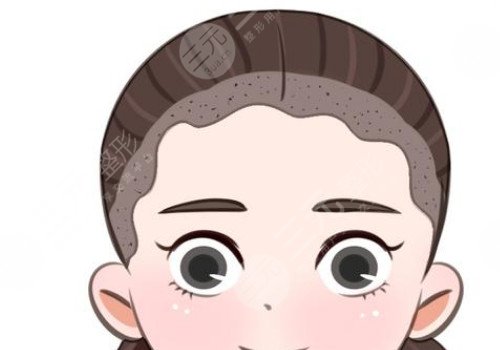 發(fā)際線移植能保持多久？