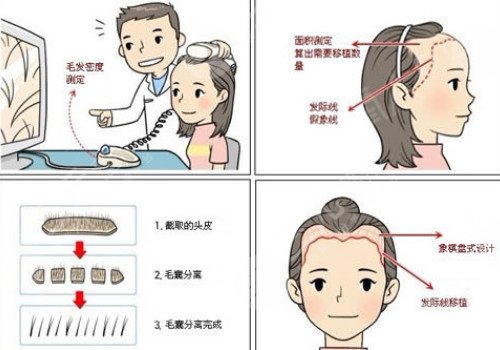 發(fā)際線移植能保持多久？