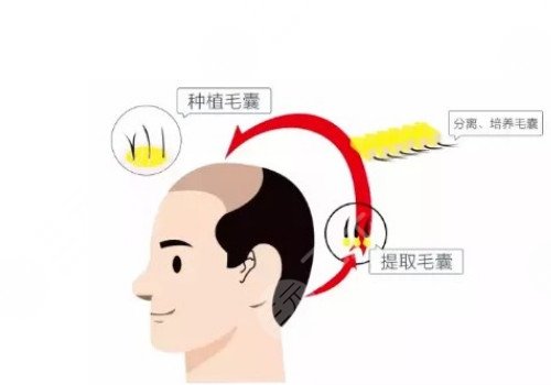 發(fā)際線移植能保持多久？