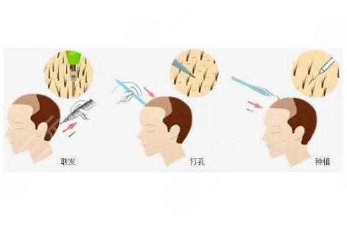 發(fā)際線移植能保持多久？