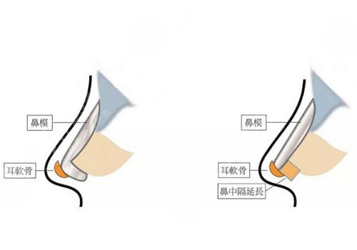 自體軟骨隆鼻多少錢？