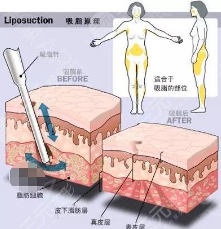 光纖溶脂