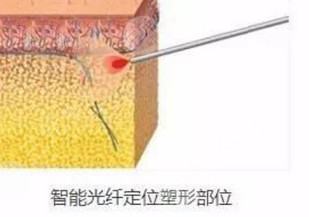 光纖溶脂