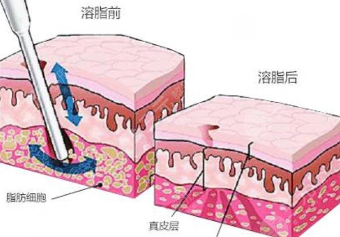 光纖溶脂