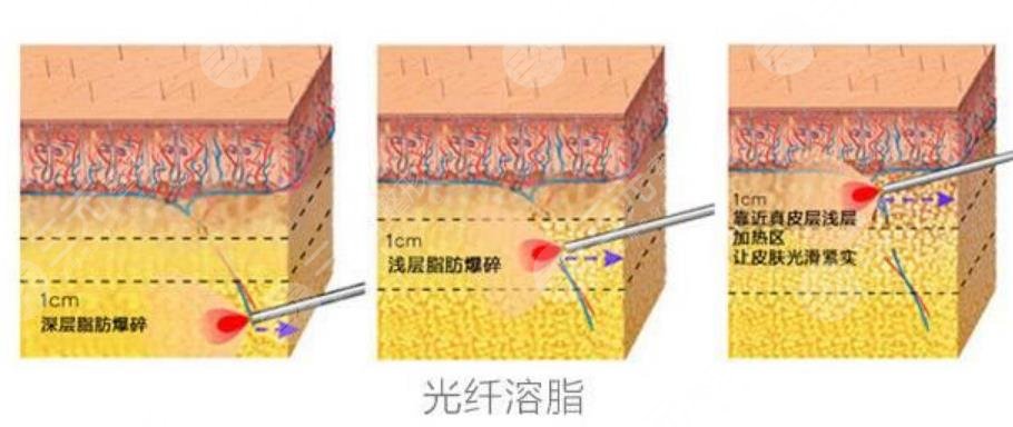 光纖溶脂