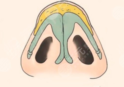 鼻頭縮小手術(shù)的費用大概是多少?