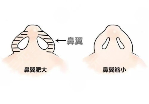 鼻頭縮小手術(shù)的費用大概是多少?