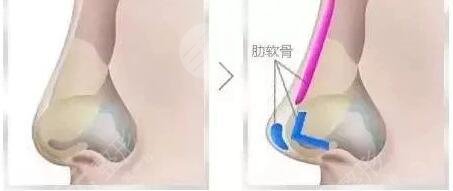 玻尿酸隆鼻子的優(yōu)點(diǎn)有哪些?