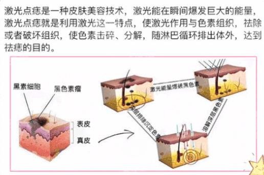 激光去痣會不會留下疤痕?