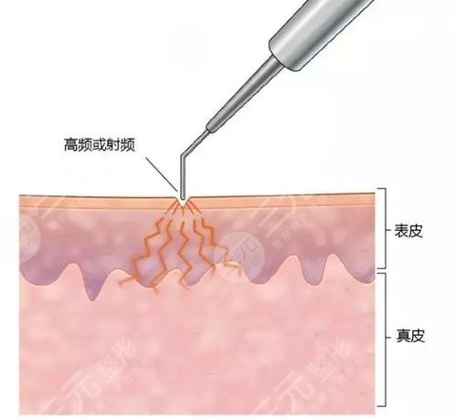 激光去痣會不會留下疤痕?