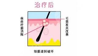 紅光緩解痤瘡幾次見(jiàn)?