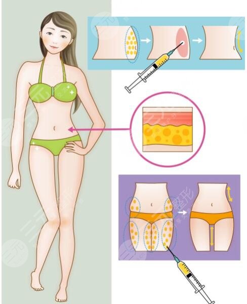 等離子激光溶脂有危害嗎？對身體有傷害嗎？副作用是什么？怎么果？