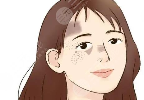 藥物祛斑