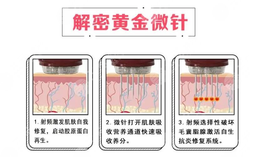 去痘價(jià)格大概多少?