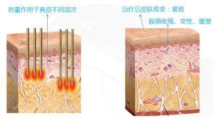 熱瑪吉的功作用及副作用揭秘