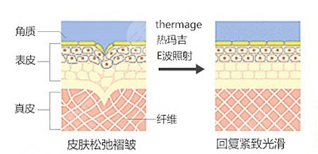 熱瑪吉的功作用及副作用揭秘