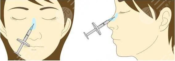 玻尿酸隆鼻對比圖前后！顏值提升僅僅需要幾分鐘，醫(yī)院內(nèi)部人員都在打卡~
