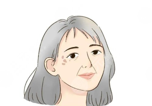 怎樣治老年斑？