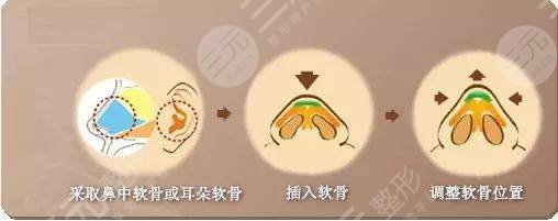 自體軟骨隆鼻特點(diǎn)