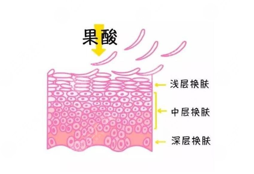 果酸換膚費用大概?多少?