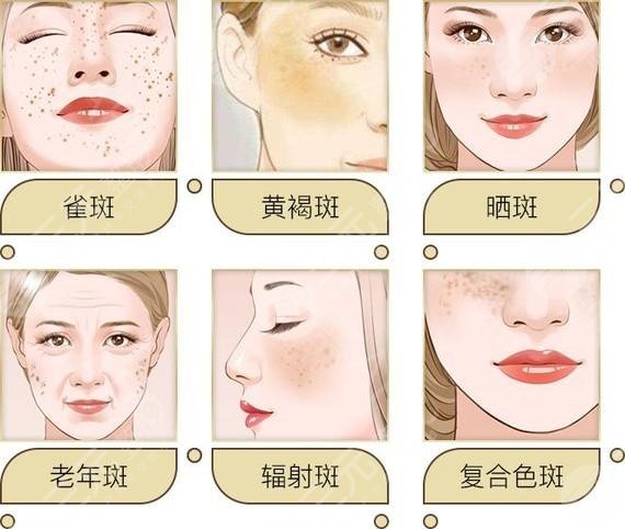 怎樣祛斑果好不反彈?