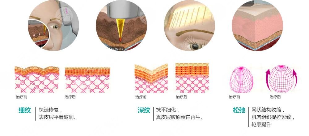 彩光祛痘果怎么樣??