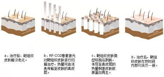 像素激光祛痘坑?果怎么樣?