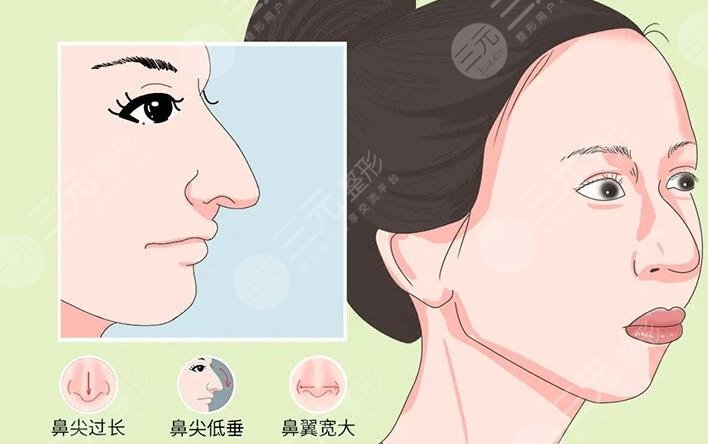 鷹鉤鼻整容整形手術(shù)多少錢(qián)2023同步更新！術(shù)前準(zhǔn)備及術(shù)后注意事項(xiàng)牢記于心！