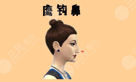 鷹鉤鼻整容整形手術(shù)多少錢(qián)2023同步更新！術(shù)前準(zhǔn)備及術(shù)后注意事項(xiàng)牢記于心！