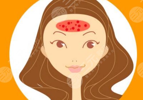 額頭長(zhǎng)了很多密密麻麻的小痘痘是什么原因？