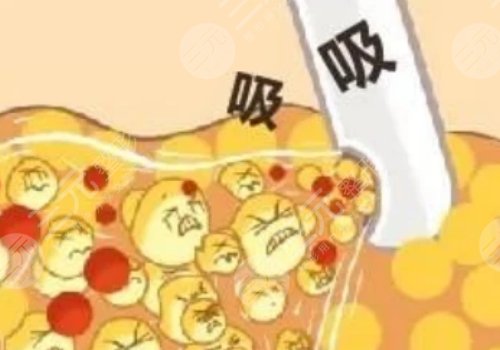 腹部抽脂術(shù)后需要修復(fù)幾天才能恢復(fù)？