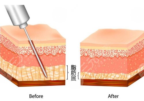 腹部抽脂術(shù)后需要修復(fù)幾天才能恢復(fù)？