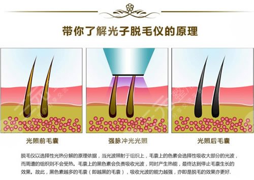 光子脫毛需要做幾次?
