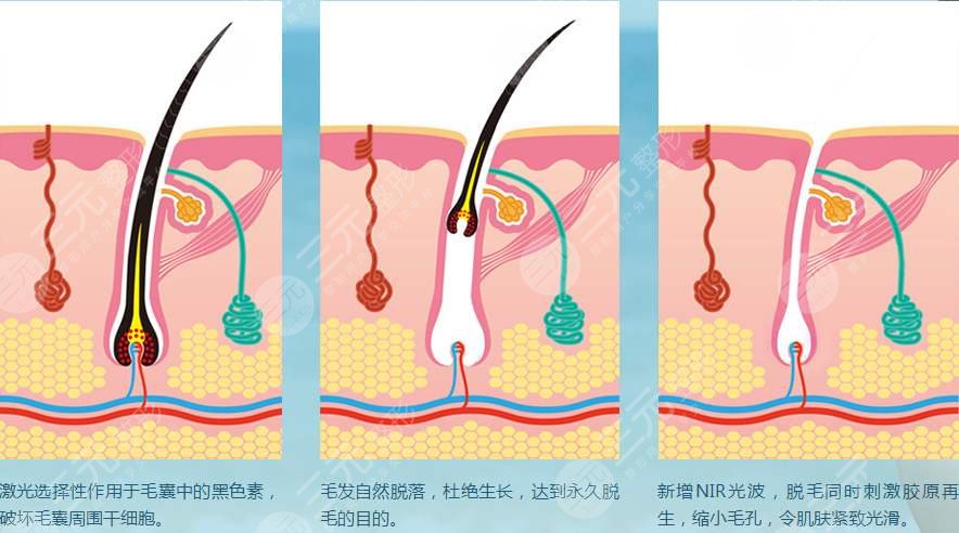 光子脫毛需要做幾次?