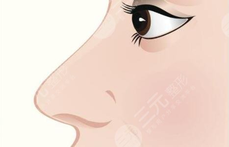 鼻尖整形大概多少錢一次2023？鼻尖整形mz方式、恢復時間、手術須知！