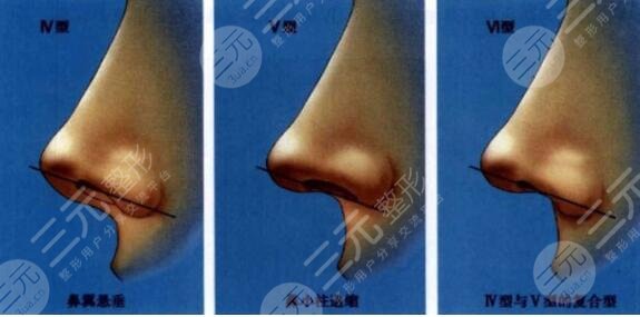 鼻尖整形多久可以恢復呢?