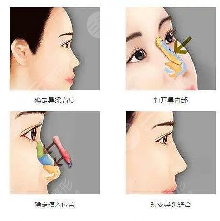 鼻尖整形之后會出現(xiàn)后遺癥嗎?