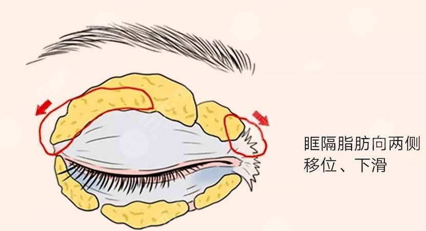 腫眼泡吸?脂一般價(jià)位是多少?