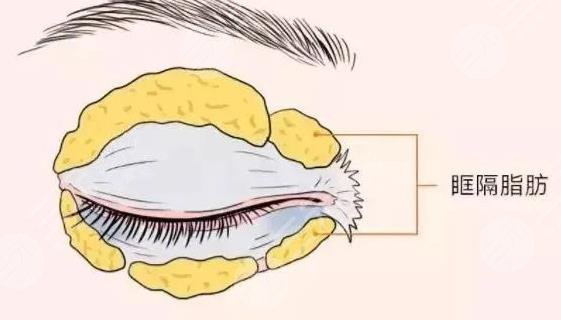 腫眼泡吸?脂一般價(jià)位是多少?