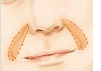 玻尿酸去法令紋需?要多少錢?
