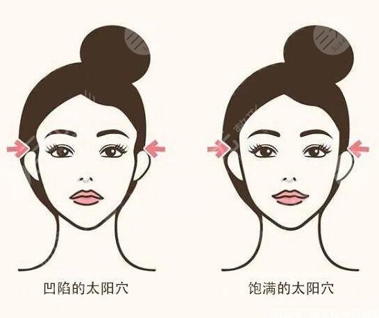 豐太陽穴多少錢價(jià)格影響因素有哪些?