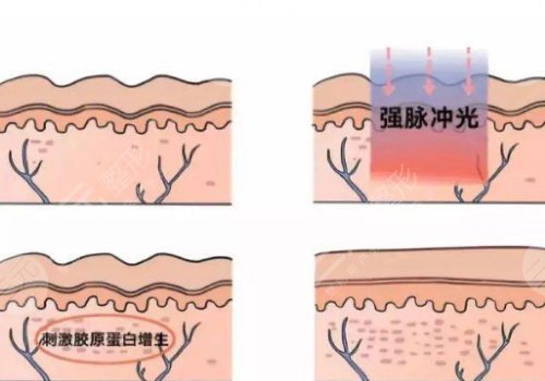 激光去疤痕需要幾次才能徹底消除？