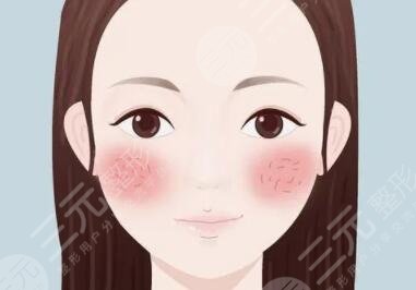 去紅血絲