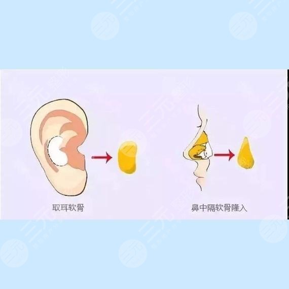 自體軟骨隆鼻效果怎?么樣?