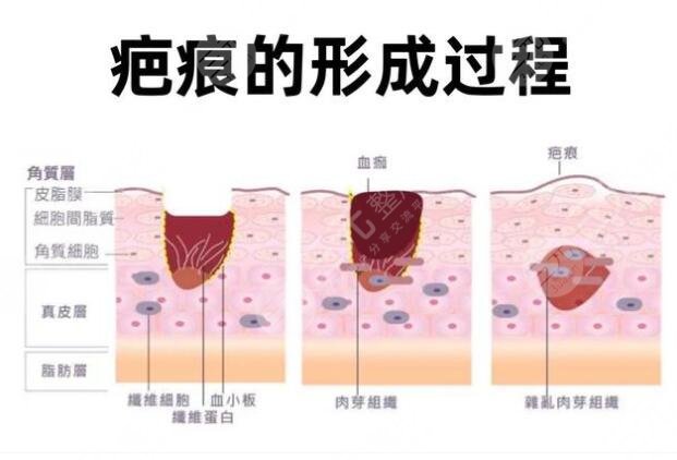 疤痕修復(fù)