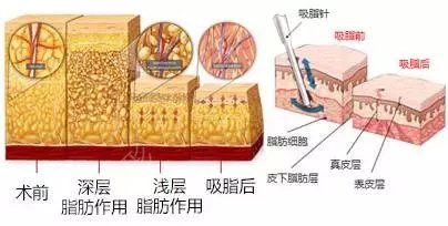 腹部吸脂肪有什么后遺癥?