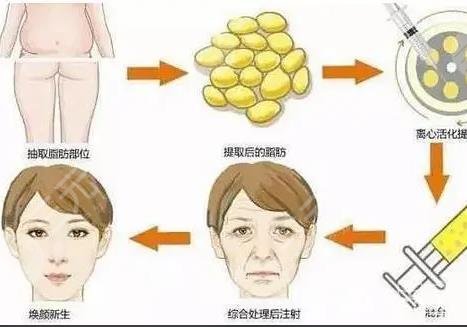 填充太陽(yáng)凹陷脂肪能保持多久?