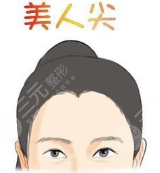美人尖種植
