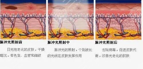 鐳射凈膚的注意事項(xiàng)有什么？