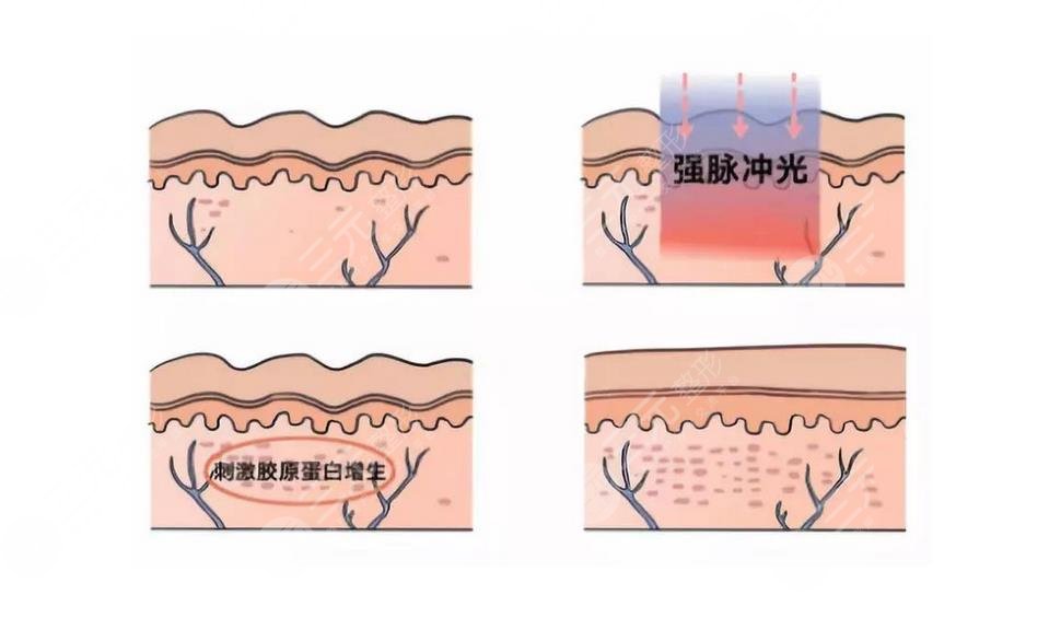快速除痘醫(yī)美方法有哪些?